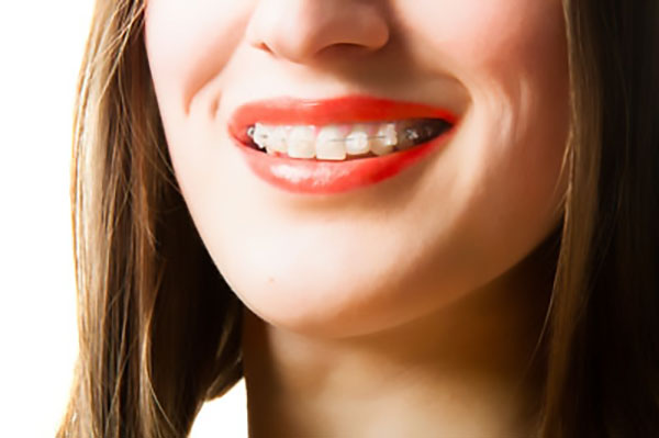 How Long Do Invisible Braces Take?